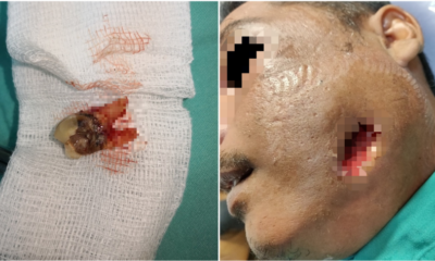 Man Applies Brake Fluid To Cure His Toothache, Got Admitted Into ICU Because Of Severe Infection - WORLD OF BUZZ 4