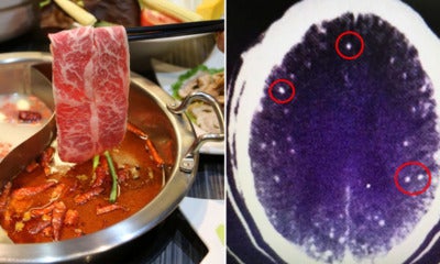 Man Get Parasitic Brain Infection From Undercooked Meat As the Redness of Mala - WORLD OF BUZZ